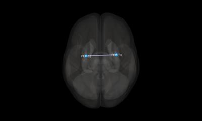 Divergent pattern of functional connectivity within the dorsal attention network differentiates schizophrenia and bipolar disorder patients